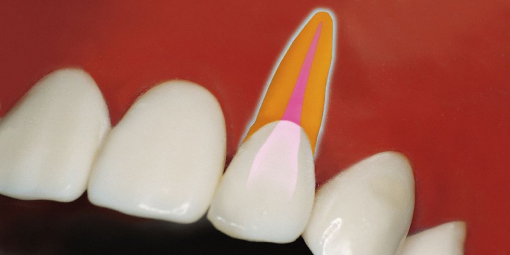 Erfolgreiche Wurzelbehandlung