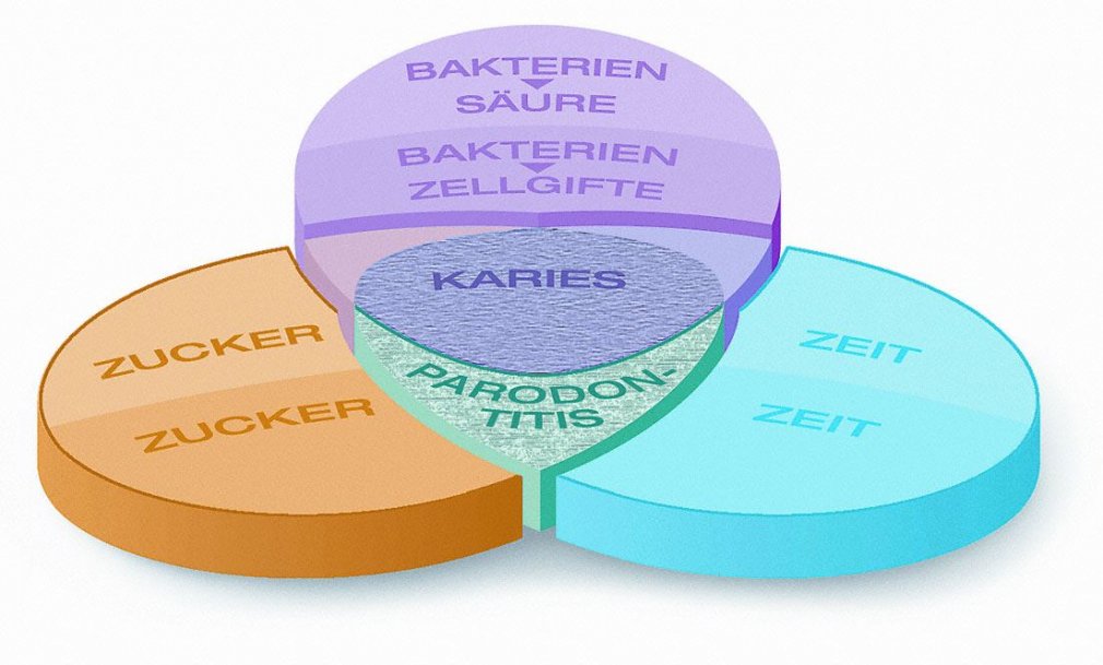 Entstehung von Karies und Zahnfleischentzündungen