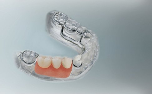 Zahnersatz bild6ze.jpg