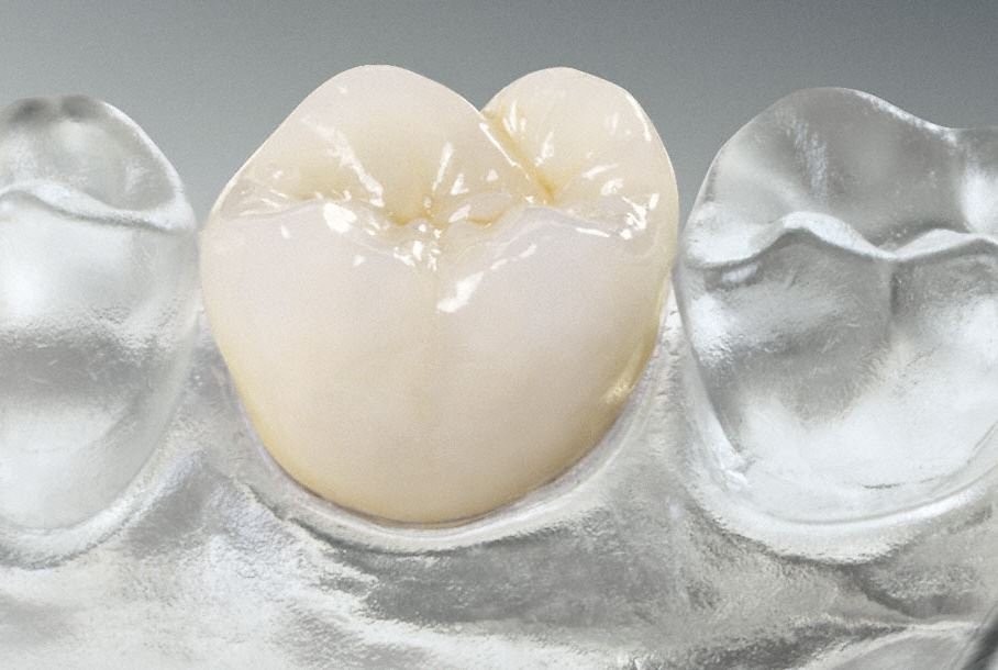 Zahnersatz bild13ae.jpg